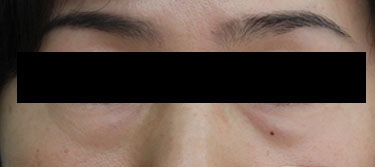 43세 여자 before
