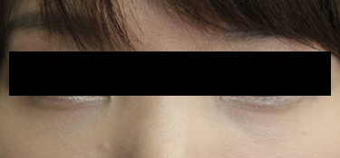 25대 여자 after